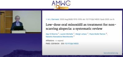 És millor el Minoxidil per via oral que no topica per al tractament de l’alopècia?