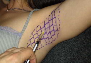 Hiperhidrosis axilar y botox